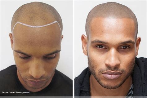 Scalp Micropigmentation 101: Pros, Cons, Cost, and .